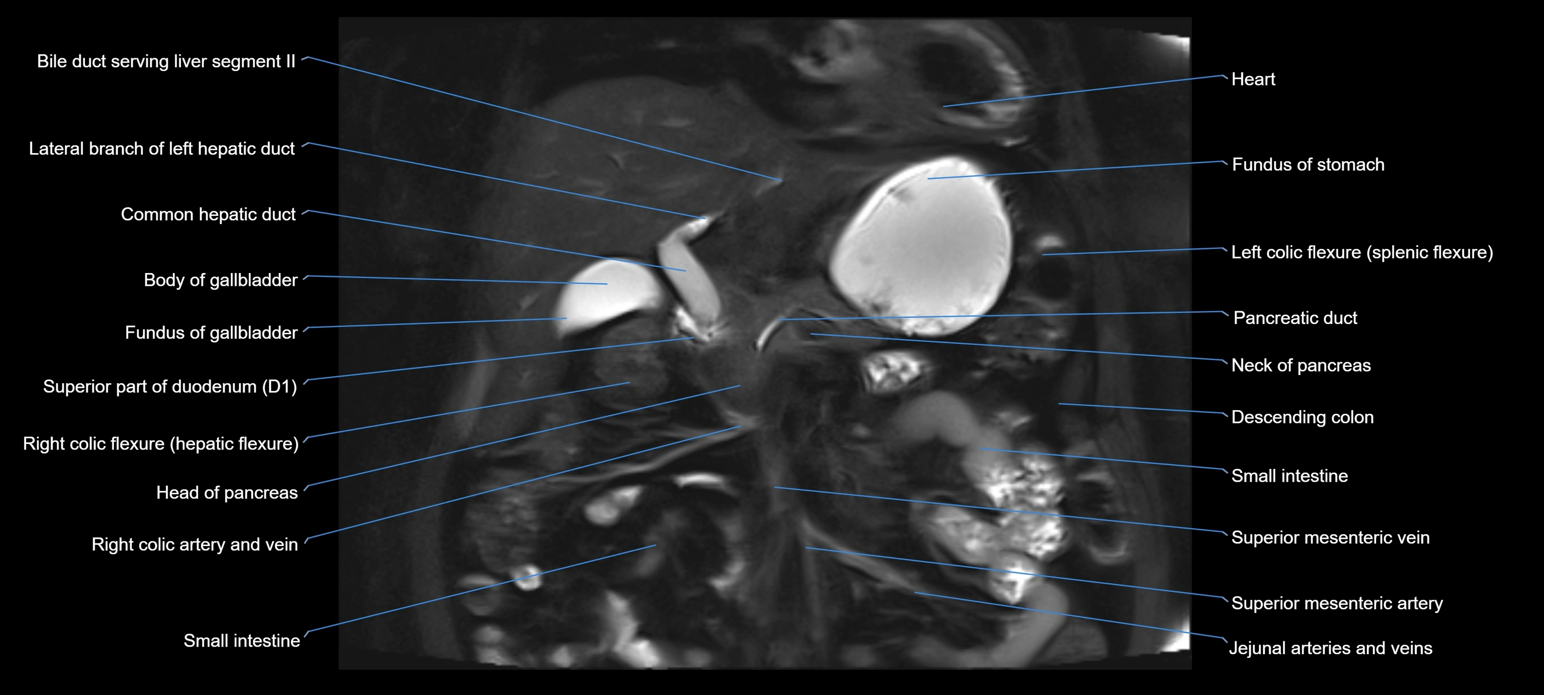 MRI MRCP coronal cross sectional 3T radiology  image-img-00001-00009.webp